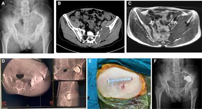 O-arm-guided percutaneous microwave ablation and cementoplasty for the treatment of pelvic acetabulum bone metastasis